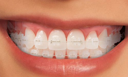 Ceramic Braces