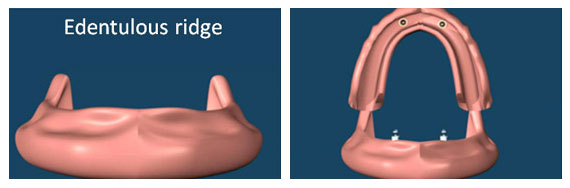 Implant supported overdentures