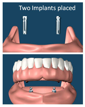 Implant supported overdentures