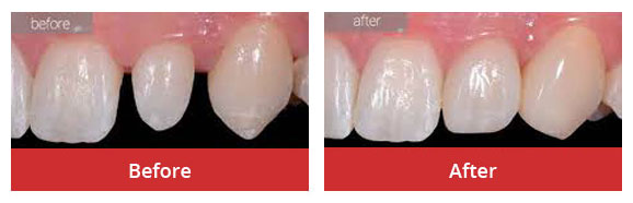 Porcelain Veneers