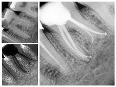Root Canal Treatment
