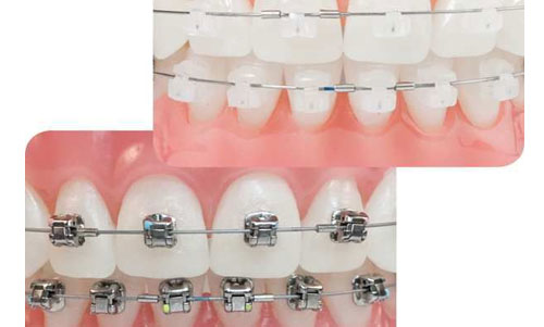 Self Ligating Braces