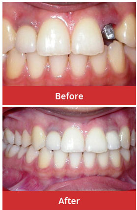 Single tooth implant