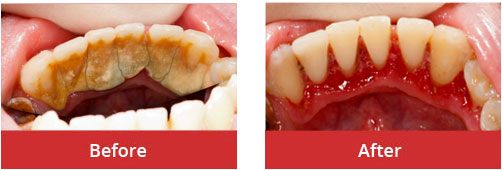 Dental Cleaning/Scaling