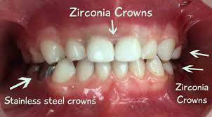Dental Crowns In Kids