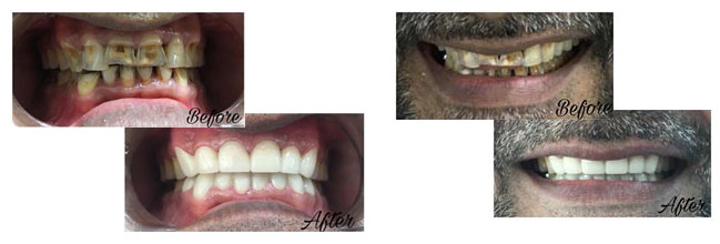 Full Mouth Reconstructions