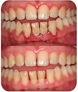 Periodontal Or Gum Treatment
