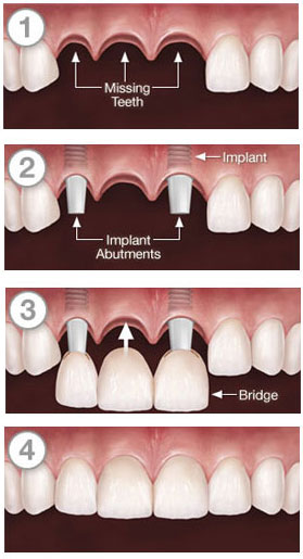 Multiple tooth replacement with Implant Bridge