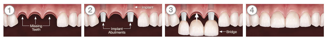 Multiple tooth replacement with Implant Bridge