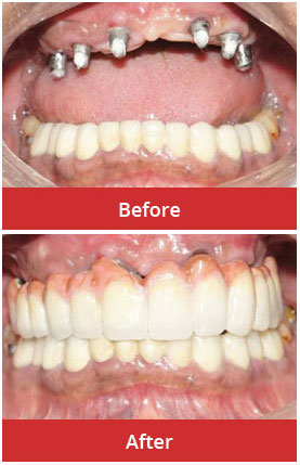 Full mouth rehabilitation with implants - Implants with fixed bridges