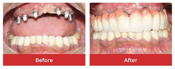 Full mouth rehabilitation with implants - Implants with fixed bridges