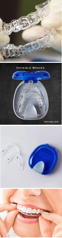 Clear Aligners /Invisalign