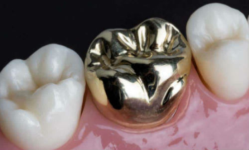 Metal Dental Crown
