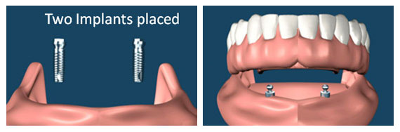 Implant supported overdentures
