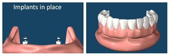 Implant supported overdentures