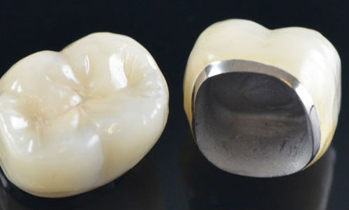 Porcelain-fused-to-metal dental crowns