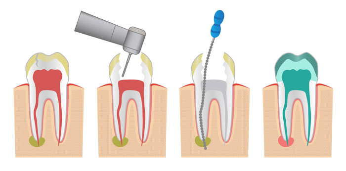 Single Sitting Root Canal