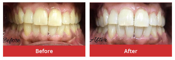 Teeth Whitening/ Dental Bleaching