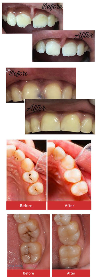 Composites/Tooth Coloured Fillings