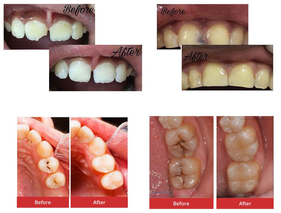 Composites/Tooth Coloured Fillings