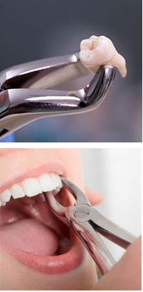 Oral Surgery/ Tooth Extraction