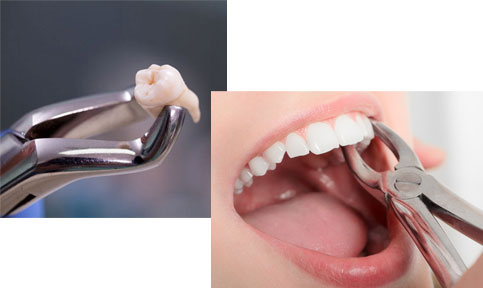 Oral Surgery/ Tooth Extraction